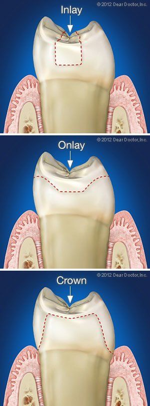 inlays, onlays, and crowns