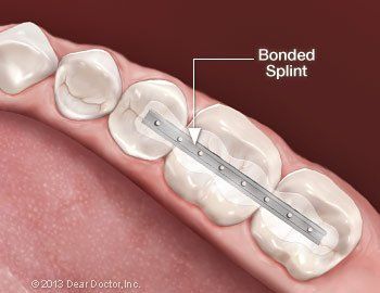 bonded splint