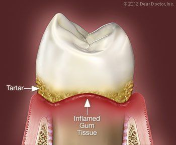 inflamed gum tissue