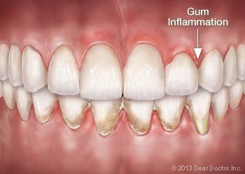 gum inflammation