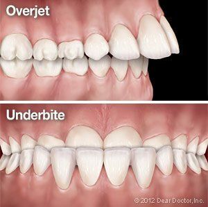 A picture of an overjet and underbite teeth