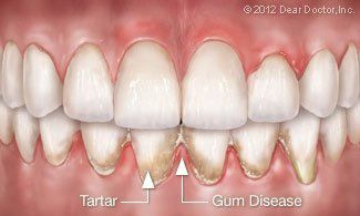 tartar and gum disease