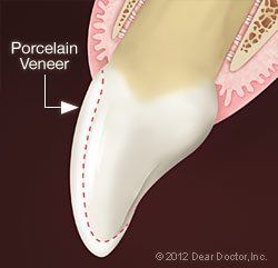 porcelain veneer