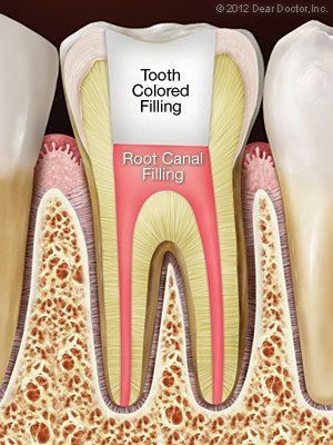 after root canal filling