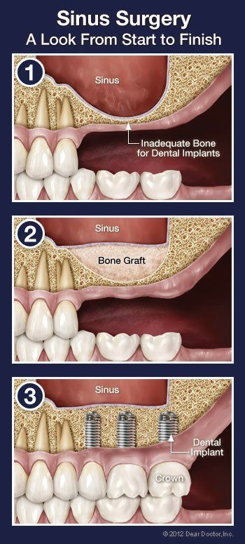 sinus surgery procedure