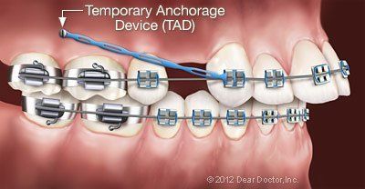 temporary anchorage device