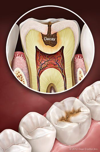 decay in tooth