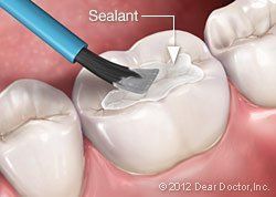An illustration of a tooth being sealed with a sealant.