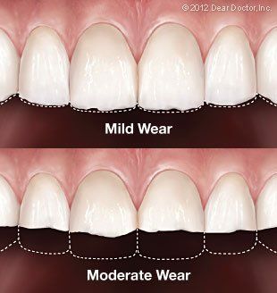 mild wear and moderate wear