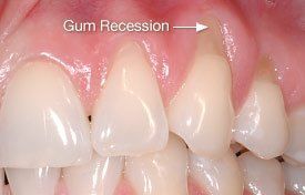 gum recession