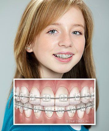 girl smiling wearing ceramic braces