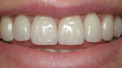 A close up of a person 's teeth with white teeth.