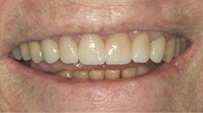 Before and after results Sewell Dental