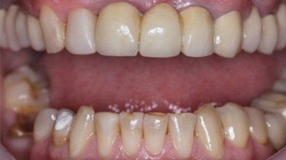before and after at Sewell Dental