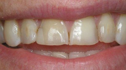 Before and After Sewell Dental
