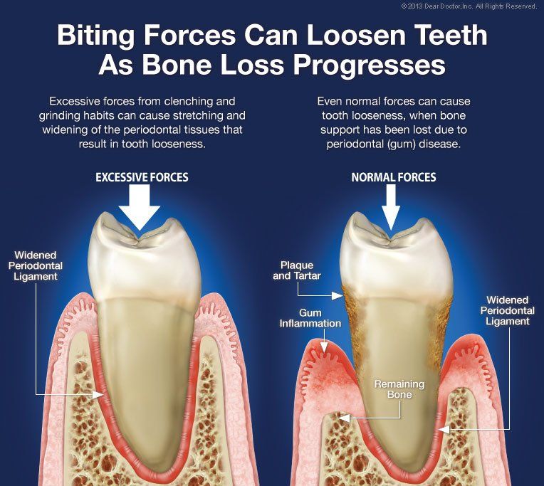 bone loss progression
