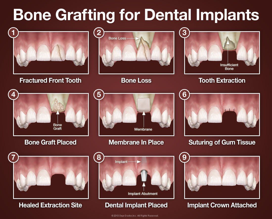 bone grafting process