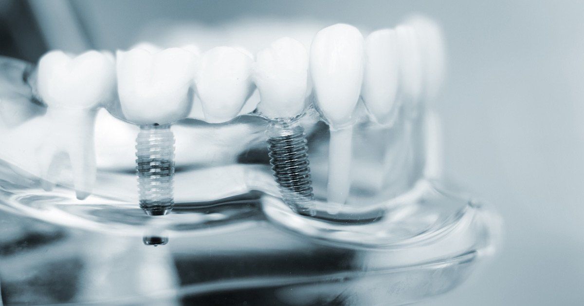 invisalign timeline