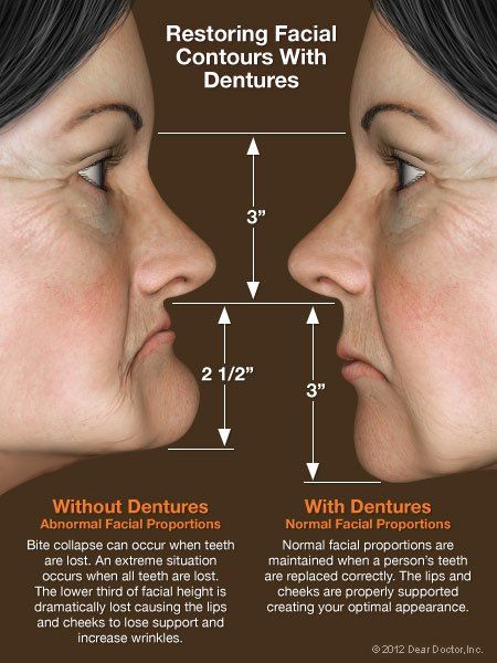 restoring facial contours with dentures