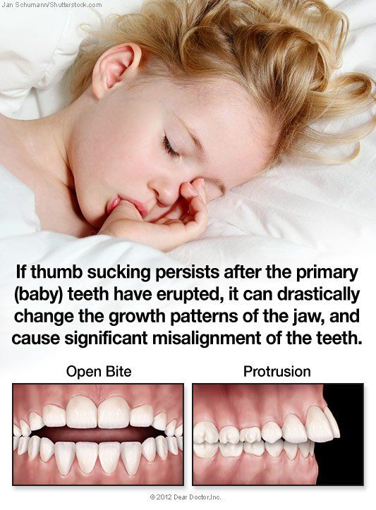 thumb sucking problems