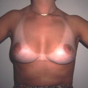 Breast Lift Dr. Joel Rein