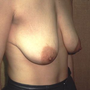 Breast Lift Dr. Joel Rein