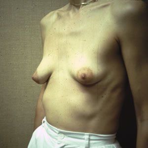 Breast Lift Dr. Joel Rein