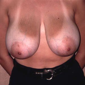 Breast Reduction Dr. Joel Rein Breast Reduction Dr. Joel Rein