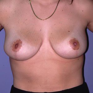 Breast Reduction Dr. Joel Rein Breast Reduction Dr. Joel Rein