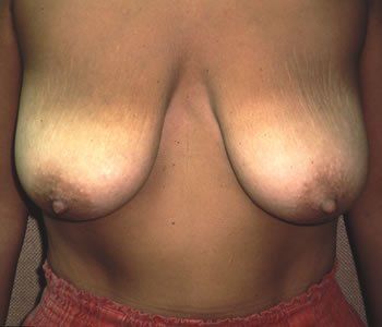 Breast Reduction Dr. Joel Rein Breast Reduction Dr. Joel Rein