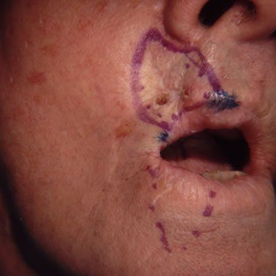 Cheek Flap Rotation