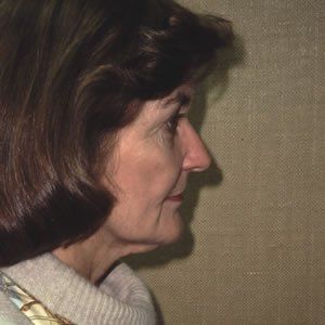 Facelift Dr. Joel Rein