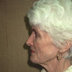 Facelift Dr. Joel Rein