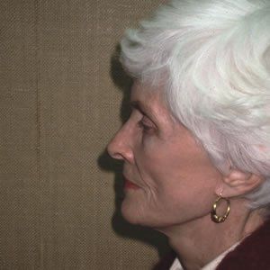 Facelift Dr. Joel Rein