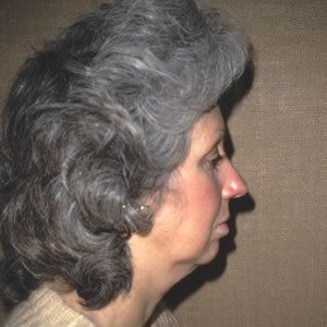 Facelift Dr. Joel Rein