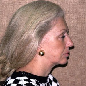 Facelift Dr. Joel Rein