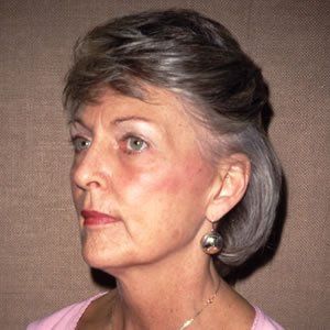 Facelift Dr. Joel Rein
