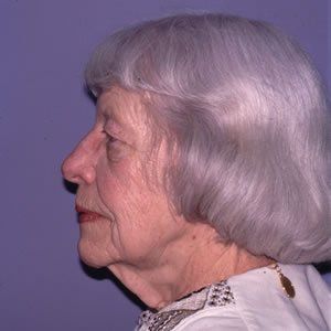 Facelift Dr. Joel Rein