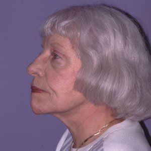 Facelift Dr. Joel Rein