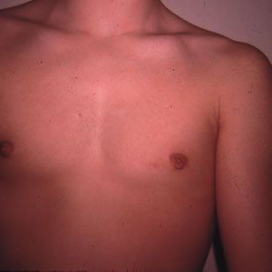 Gynecomastia Dr. Joel Rein Gynecomastia Dr. Joel Rein