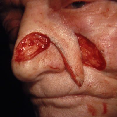 Naso-Labial Flap