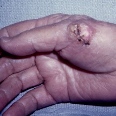 Skin Graft to Thumb