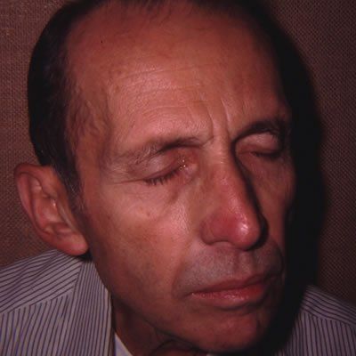 Skin Graft to Nose