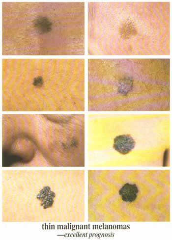 Thin Malignant Melanomas Thin Malignant Melanomas