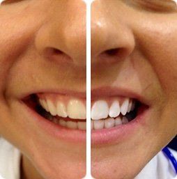 before after
