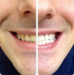 before after