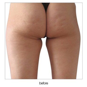 buttocks