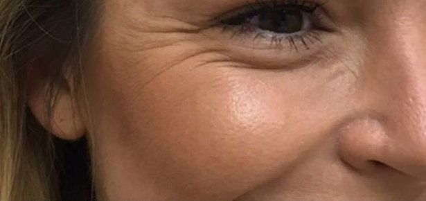 scar
