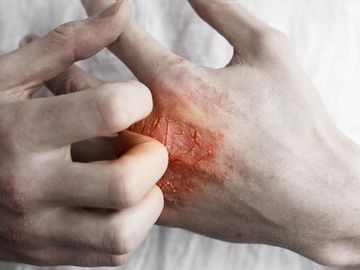 Skin Cancer — Surgical Care in North Mackay, QLD Skin Cancer — Surgical Care in North Mackay, QLD