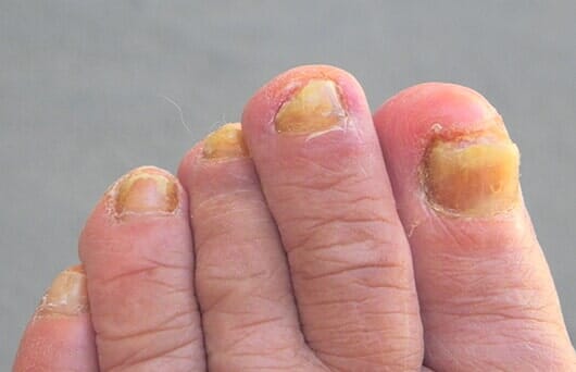 Foot with toenail fungus  — Podiatry Clinic in Eugene, OR